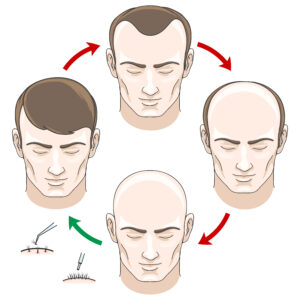 Hair Transplant Methods