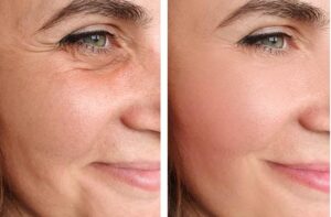 Surgical or Non-Surgical Facial Rejuvenation