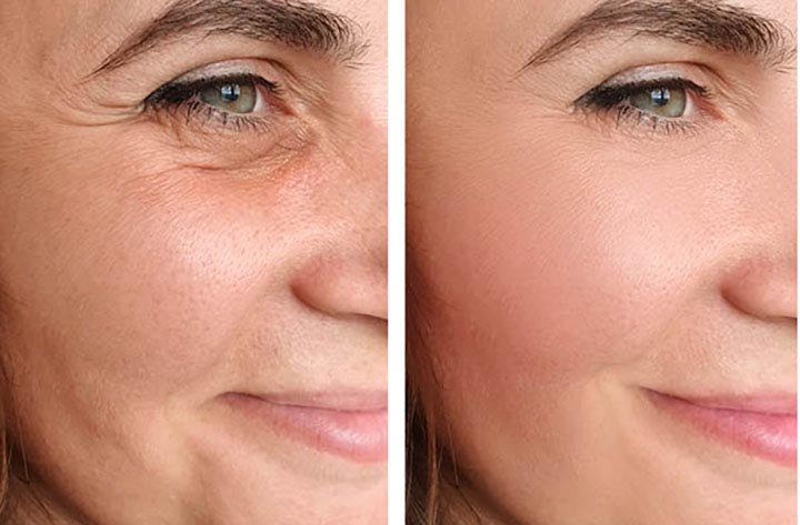 Surgical or Non-Surgical Facial Rejuvenation