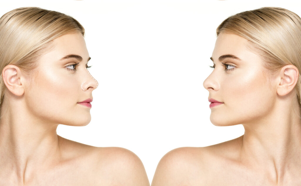 Full vs Mini Facelift