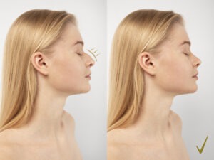 Rhinoplasty