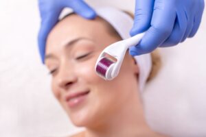 Microneedling myths