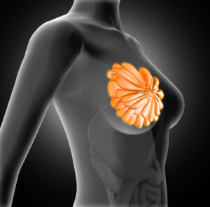 Breast implants