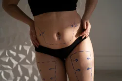 Buttock augmentation