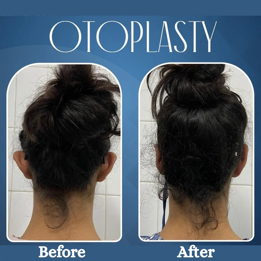 Otoplasty